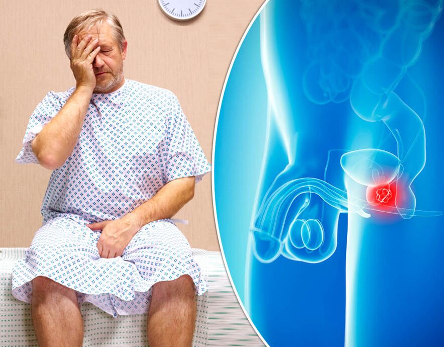 رجل مصاب بالتهاب البروستاتا يخضع لتشخيص المرض